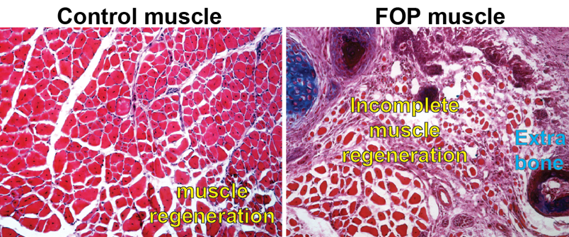 Penn research shows origin of rare disease FOP rooted in muscle regeneration dysfunction