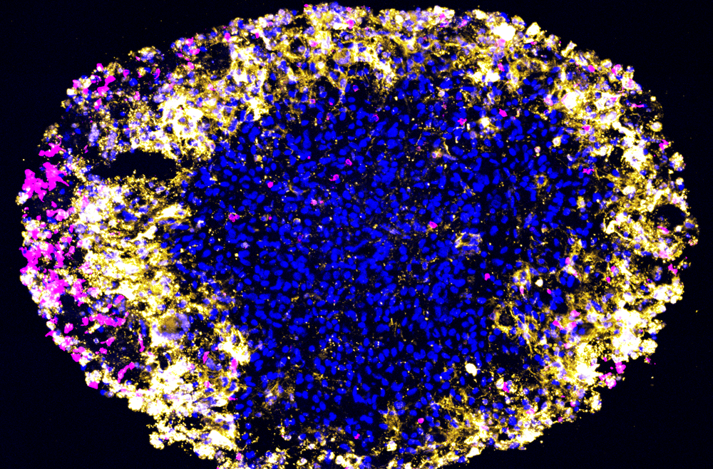 Patient-derived glioblastoma organoid treated with dual-target CAR-T cells. T cells (magenta) infiltrate the tumor organoid and kill tumor cells (blue) (yellow indicates dying cells). Image by Yusha Sun and Xin Wang from the laboratories of Guo-li Ming and Hongjun Song.